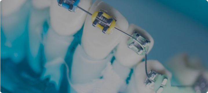 Wire Bio detan braces